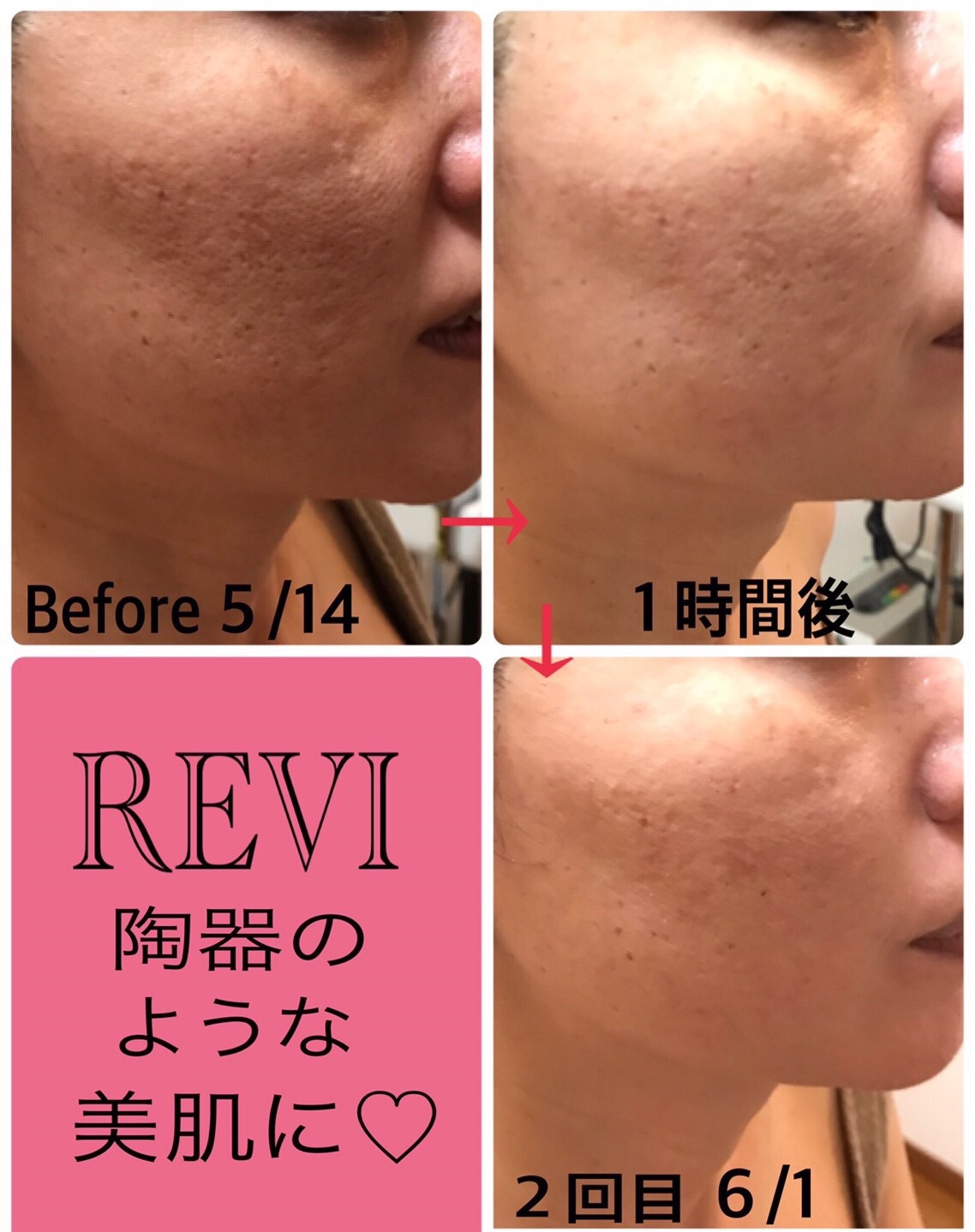 REVI】陶器トリートメント5回 - www.nstt.fr