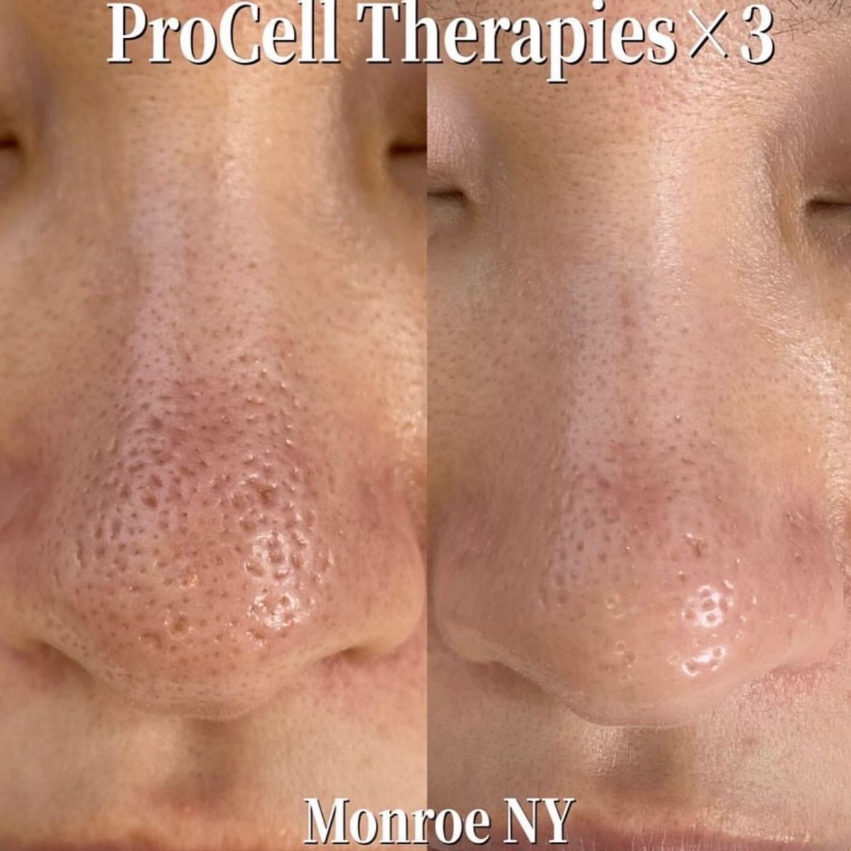 美肌トリートメント（プロセルセラピーズ🇺🇸）トライアル-a cozy